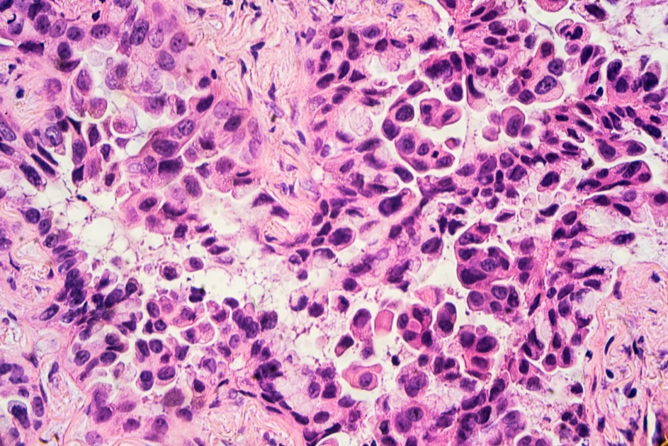 FFPE cancer tissue sample FFPE cancer tissue sample