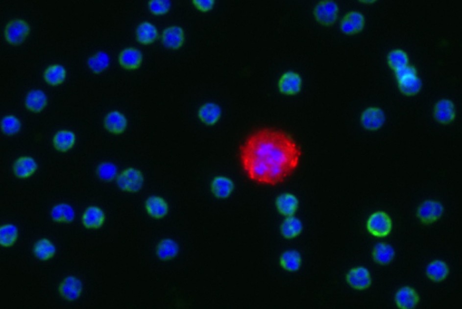 IF labelled circulating tumor cell (CTC) with surrounding leucocytes IF labelled circulating tumor cell (CTC) with surrounding leucocytes